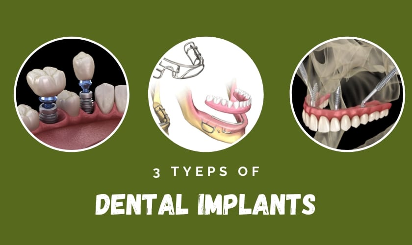 image of dental implant-what are the 3 types of dental implants