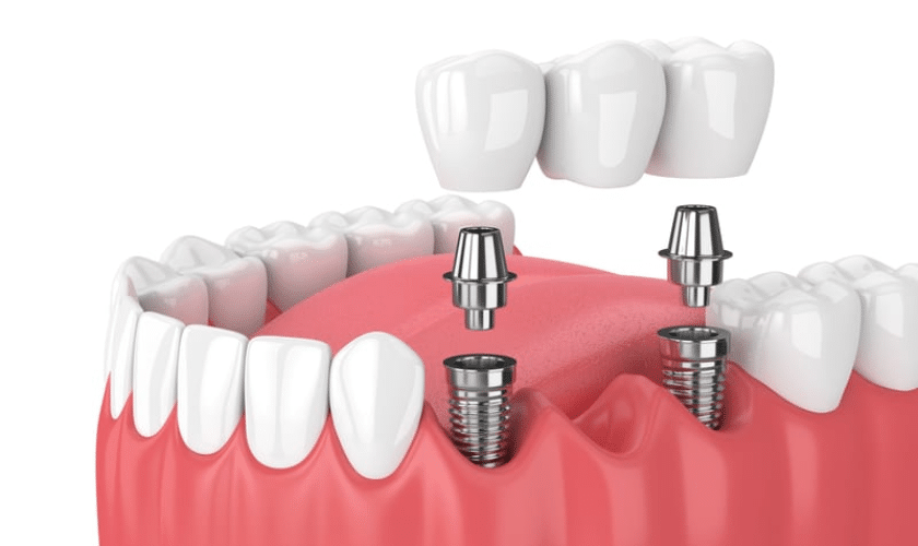 Image of Dental Bridges-Are Dental Bridges Right For You? Everything You Need To Know