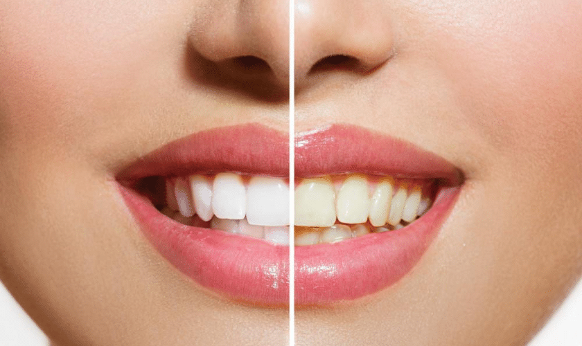 What's The Best Way To Whiten Your Teeth
