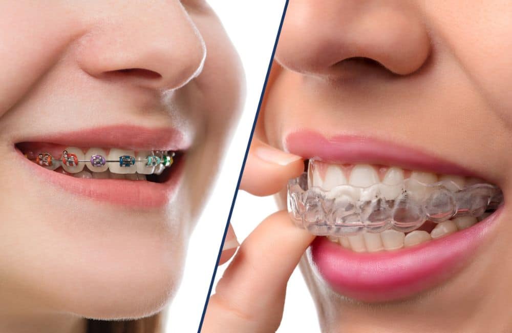 Pros And Cons Of Invisalign Dentist And Traditional Dentists