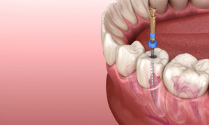 how long can a root canal take to heal