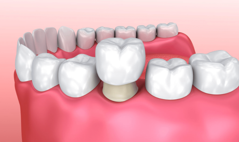 How To Care For Your Dental Crowns