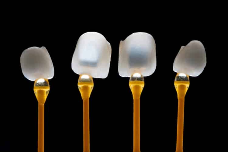 Can Veneers Correct your Overbite? Cosmetic Dentistry Explained
