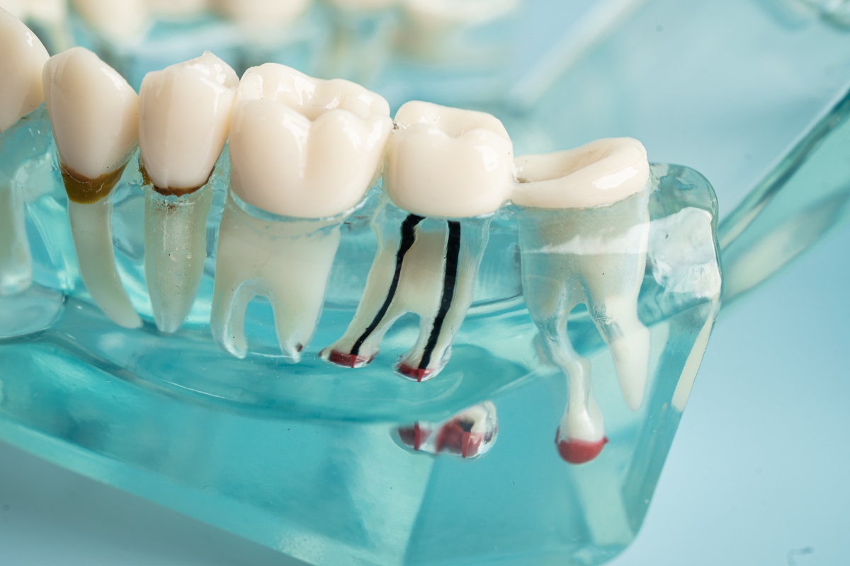 root-canal-therapy-in-Sioux-City