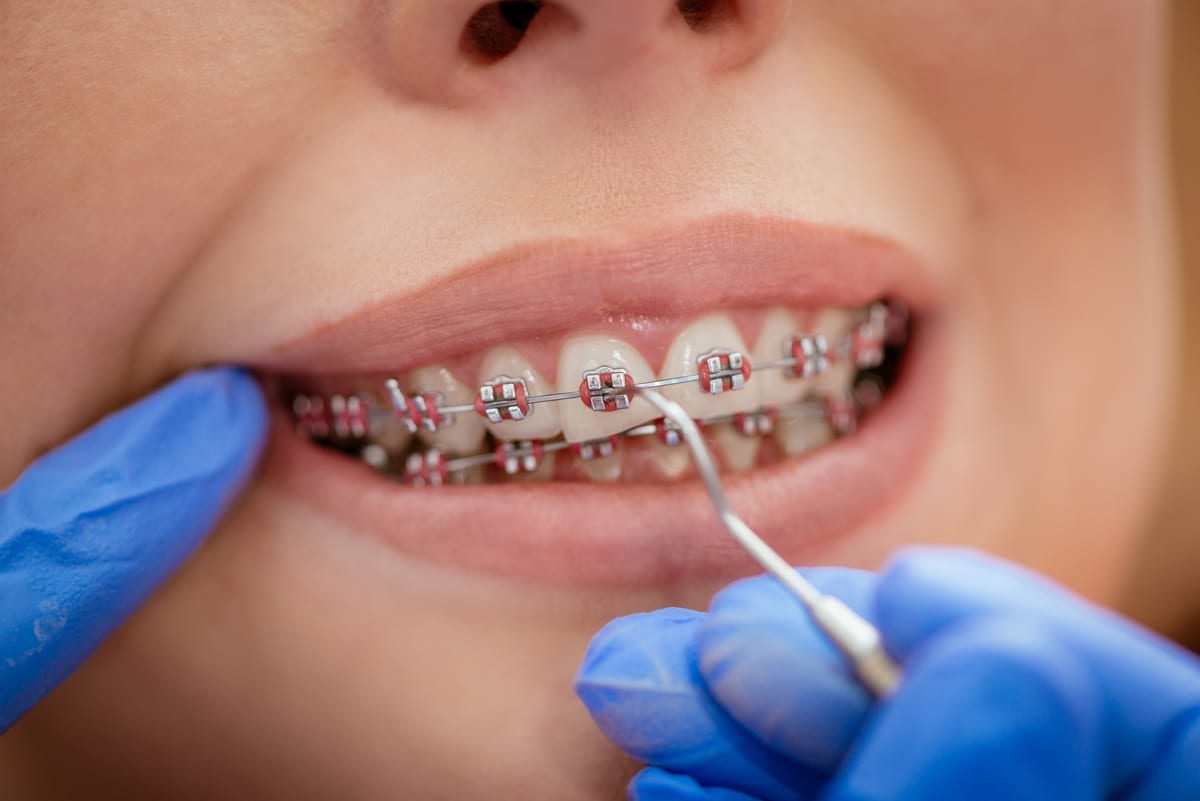 Dental Bridges in Sergeant Bluff